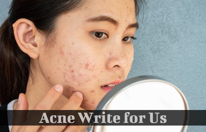 Acne Write for Us